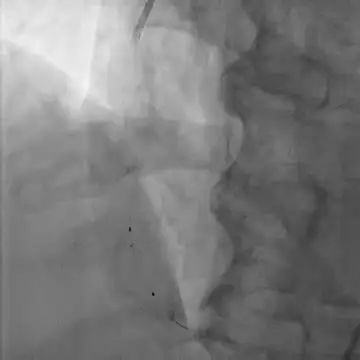 Dr Robinson positioning protection device in Vein Graft