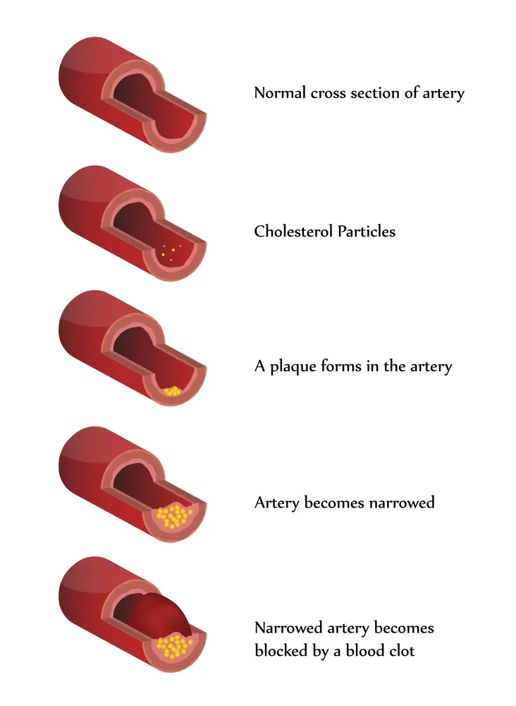 Hypercholesterolaemia
