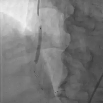 Placement of Stent in vein graft