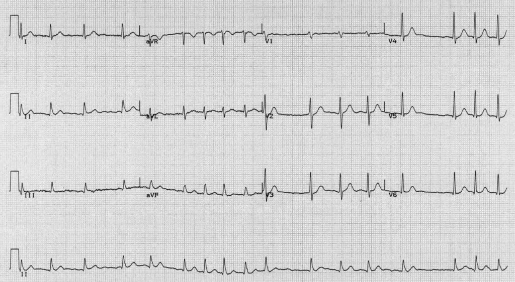 Cardioversion