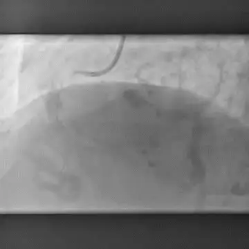 Normal flow restored after stent insertion