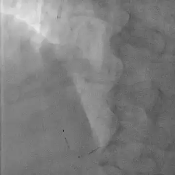 Removal of protection device